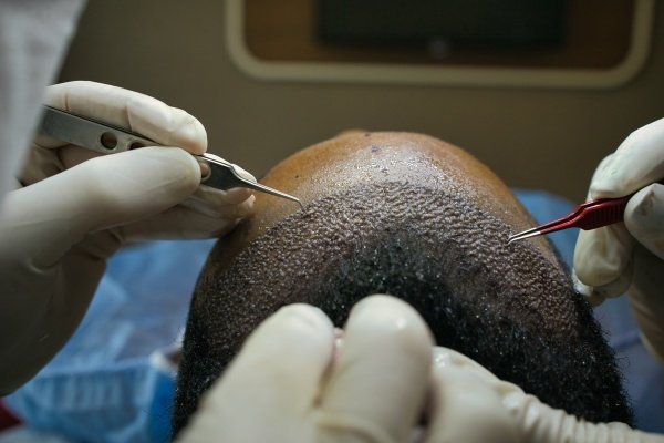 can hair transplant cause cancer lets find out with fut/ fue tranplant procedure 