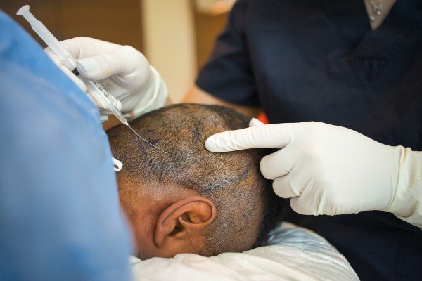 does hair transplant consider safe 