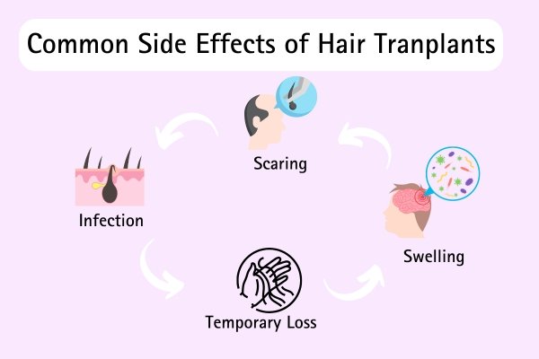 common side effecgt of hair transplant that include swelling, scaring, hair loss, infection